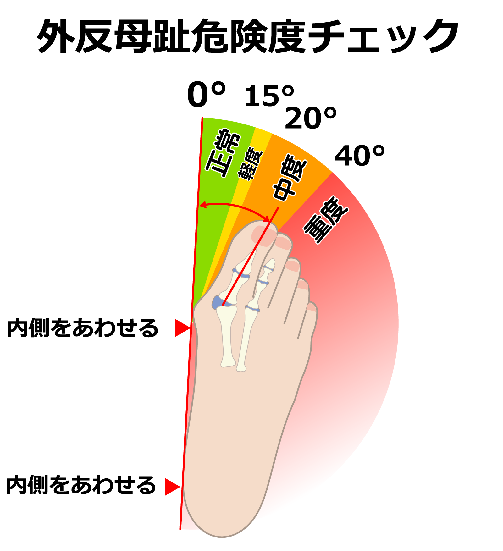 外反母趾危険度チェック